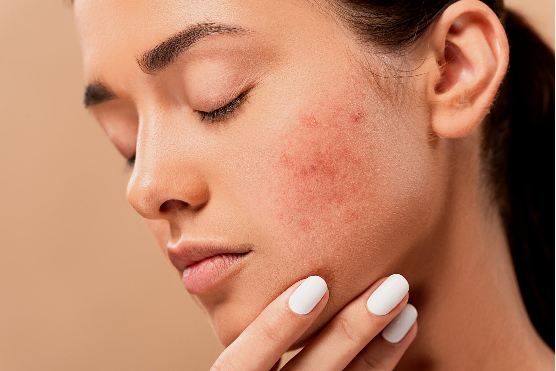 What-Causes-Acne
